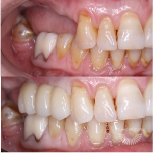 female teeth implant