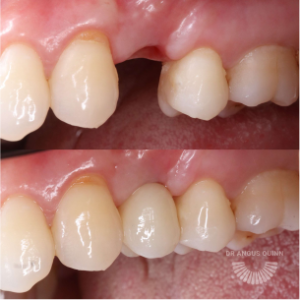 male teeth implant