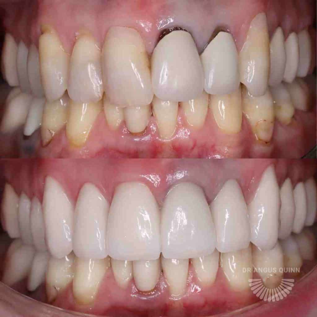 Dental Crown: Before and After