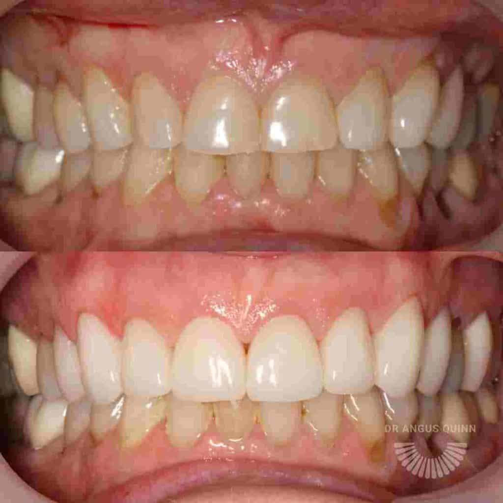 Dental Crowns: Before and After
