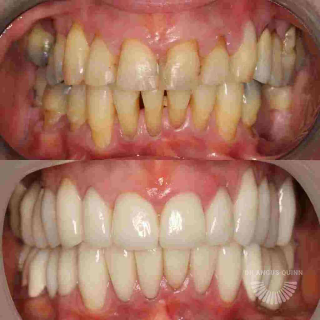 Dental Crowns: Before and After